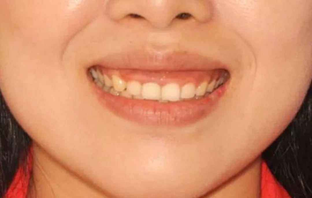 门牙有缝隙应该怎么办_门牙咬不到下牙有缝隙_男人门牙有缝隙的相学